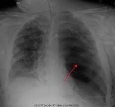 Tension Pneumothorax