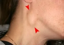 Lymphadenopathy