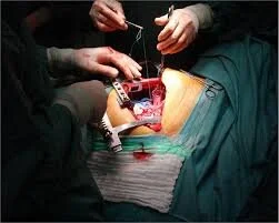 Surgical Treatment of Lung Cancer