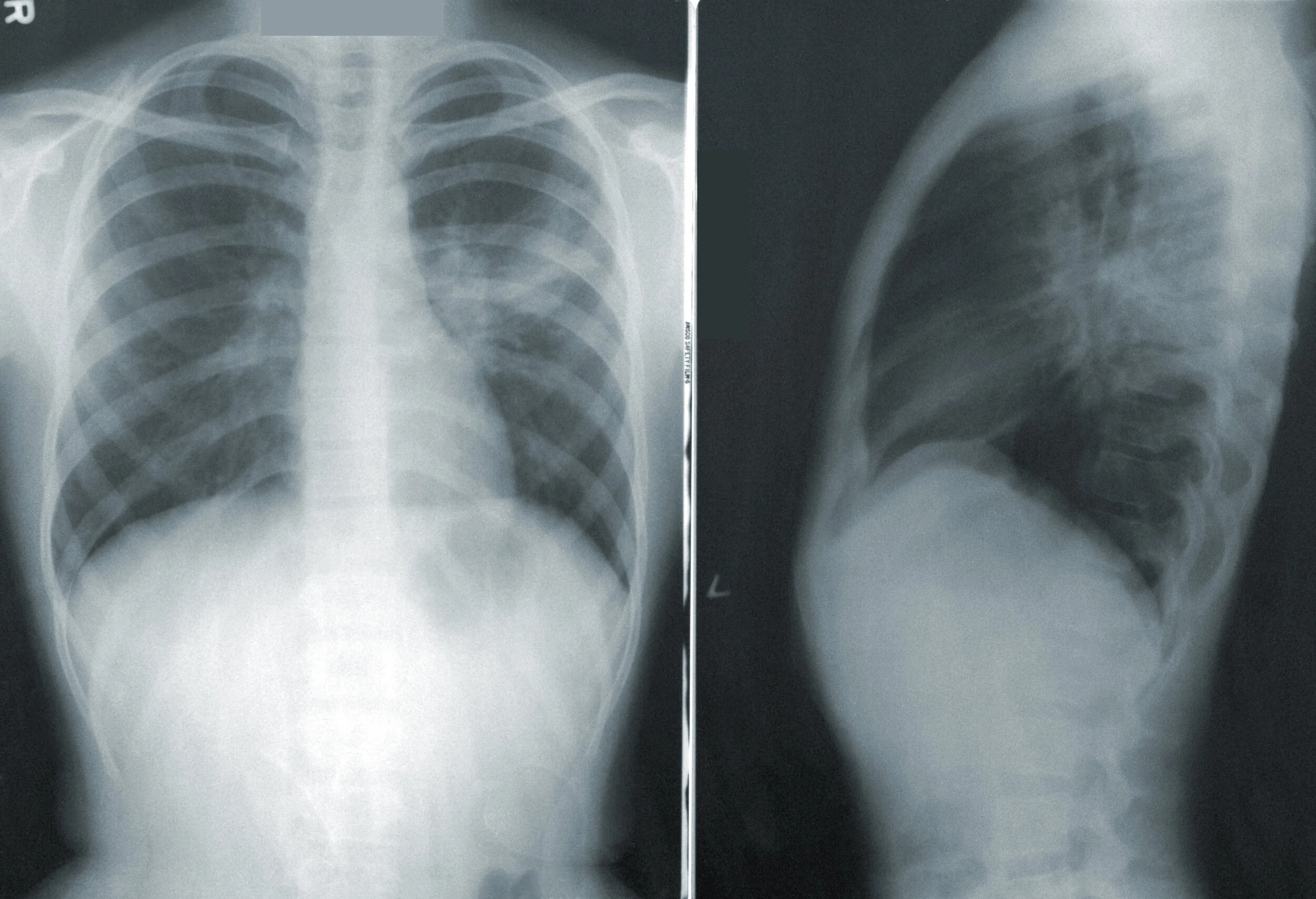 Radiologic Imaging for Lung Cancer