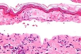 Stevens-Johnson Syndrome (SJS) / Toxic epidermal necrolysis (TENS)