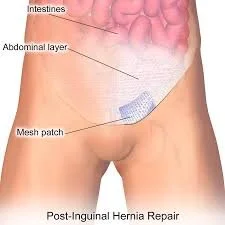 Inguinal hernias and mesh removal