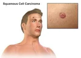 Treatment of Head and Neck Squamous Cell Carcinomas — Medilex: The ...
