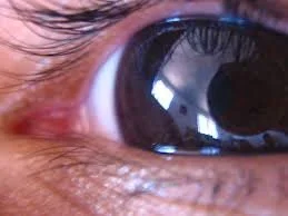 Preservation of the Optic Nerve in Glaucoma