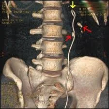 Ureteric Stent Placement