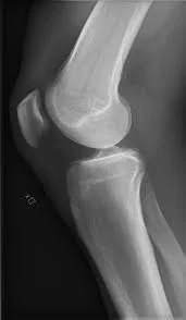 Cold Therapy Following Knee Arthroscopy