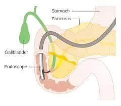Endoscopic Retrograde Cholangio-pancreatography (ERCP)