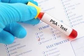 Prostate Specific Antigen (PSA)