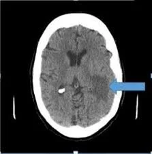 temporal lobe mass lesions