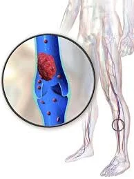 Deep Vein Thrombosis & Pulmonary Embolus
