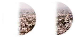 Visual field loss (or visual field cut)