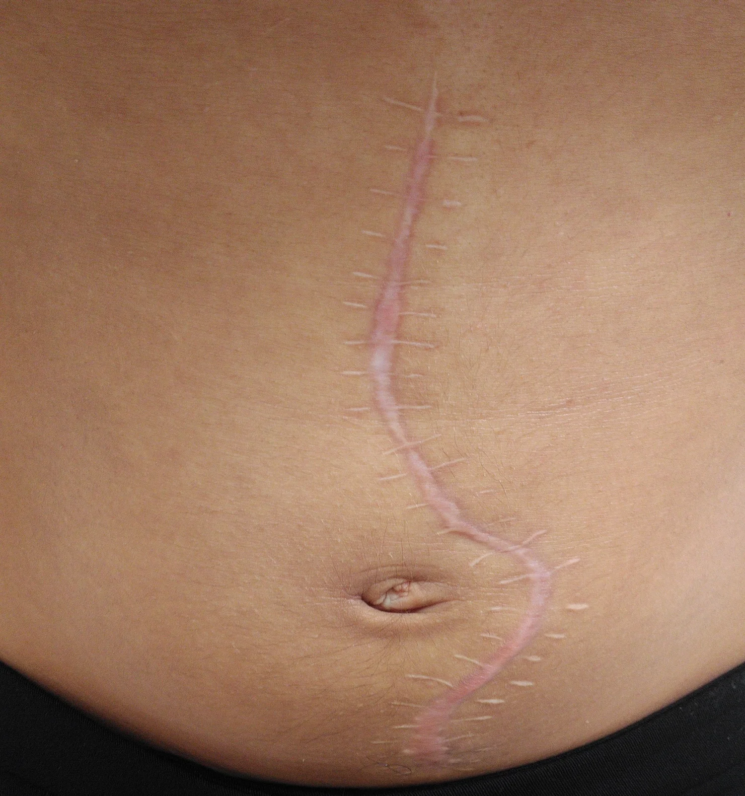 Ruptured Appendix Scar