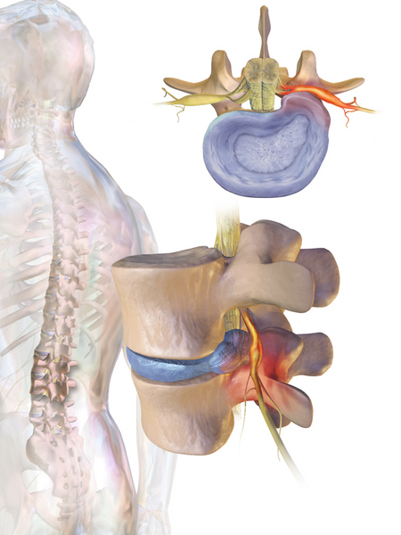 لماذا قد يسبب اعوجاج العمود الفقري ألمًا في الرجل؟