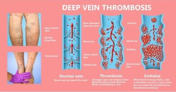 Risk Factors for Deep Venous Thrombosis