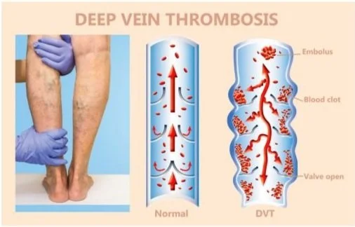 Acquired Versus Inherited Risk Factors for Deep Venous Thrombosis