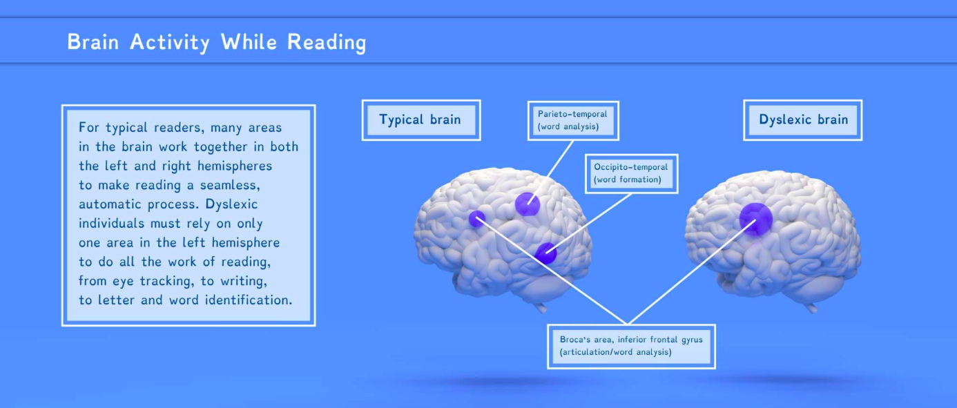 What Reading Really Looks Like When You’re Dyslexic