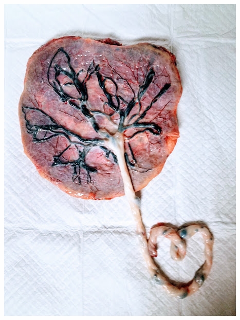 This is an image of a real placenta that has been rinsed clean, with intact umbilical cord fashioned into the shape of a heart.