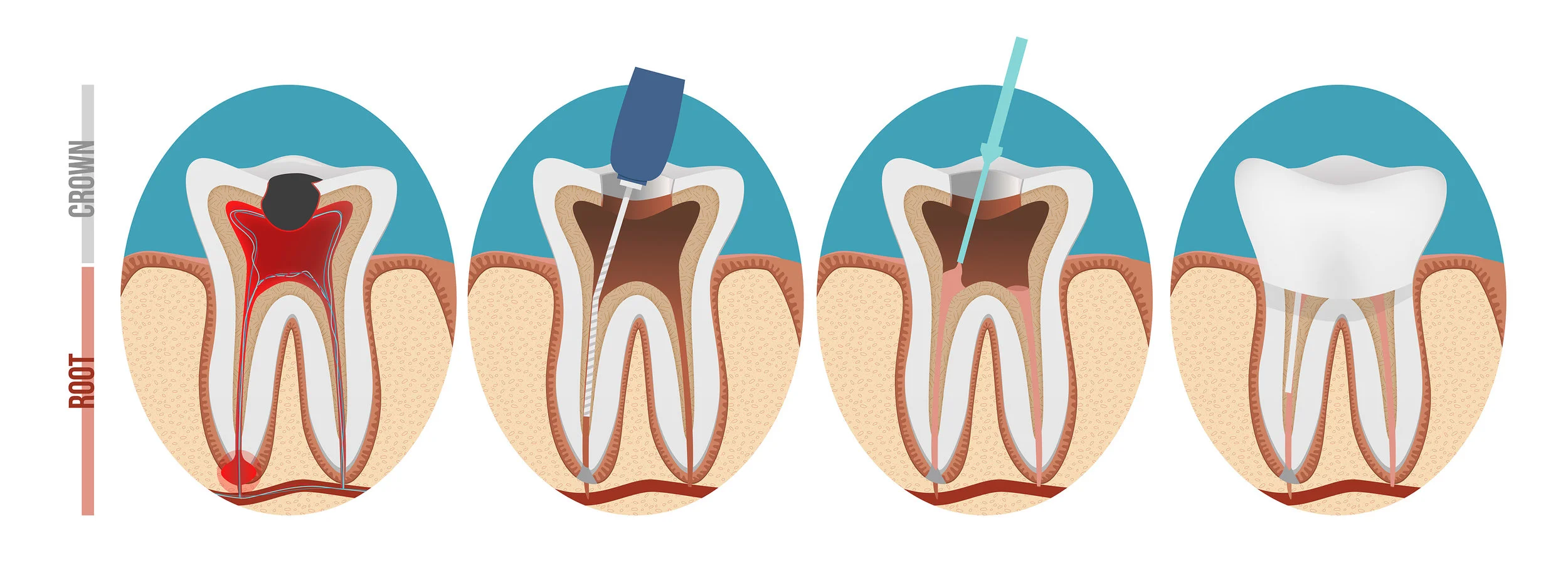 abbey-dental-care-root-filling.jpg