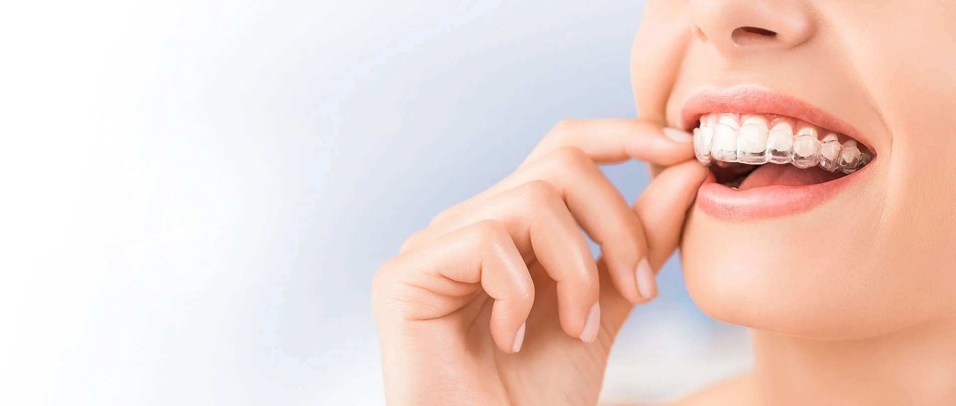 Abbey-Dental-Care-Invisalign-Services-in-Kent.jpg
