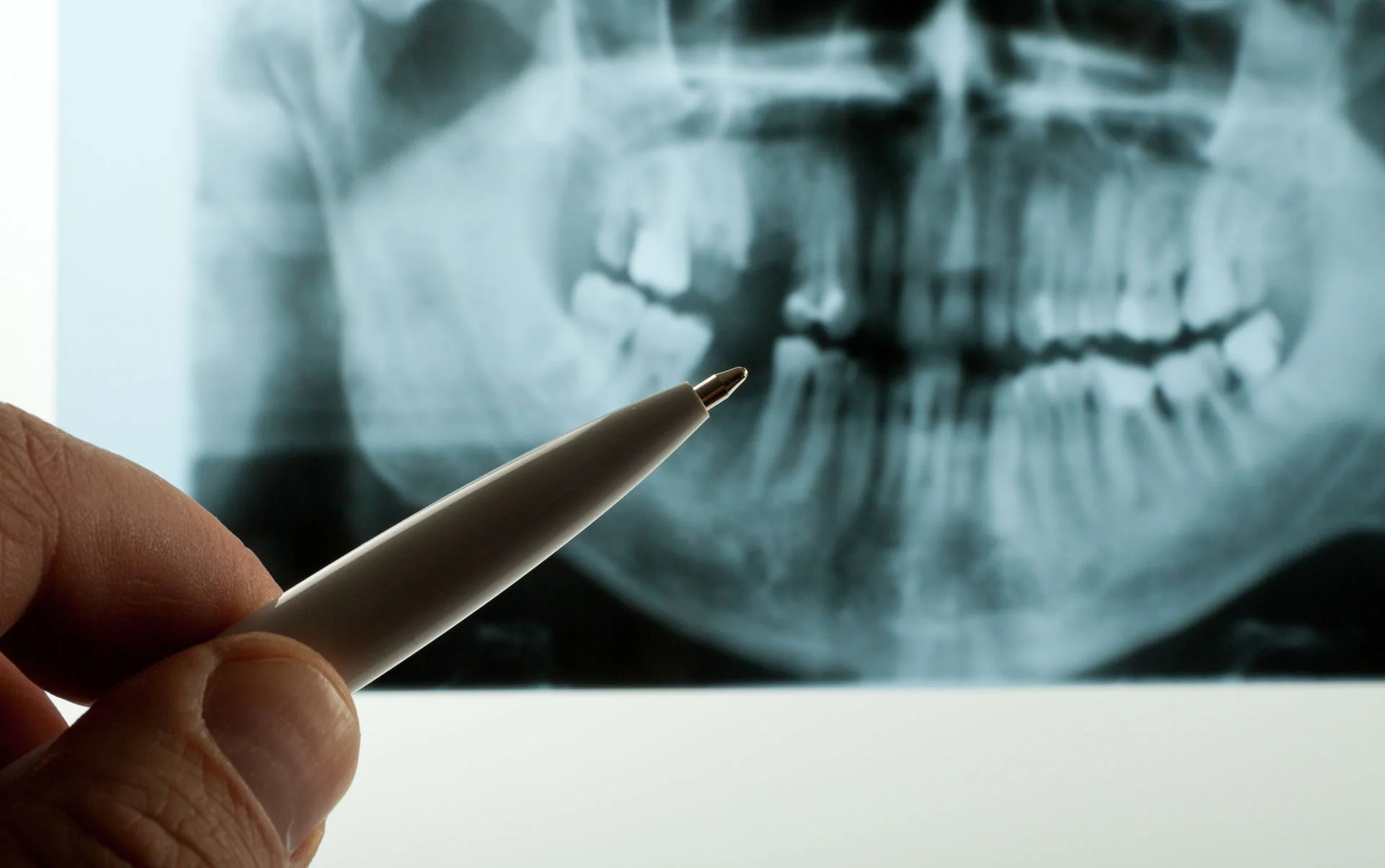 Abbey-Dental-Care-Zygomatic-Implants-Service.jpg