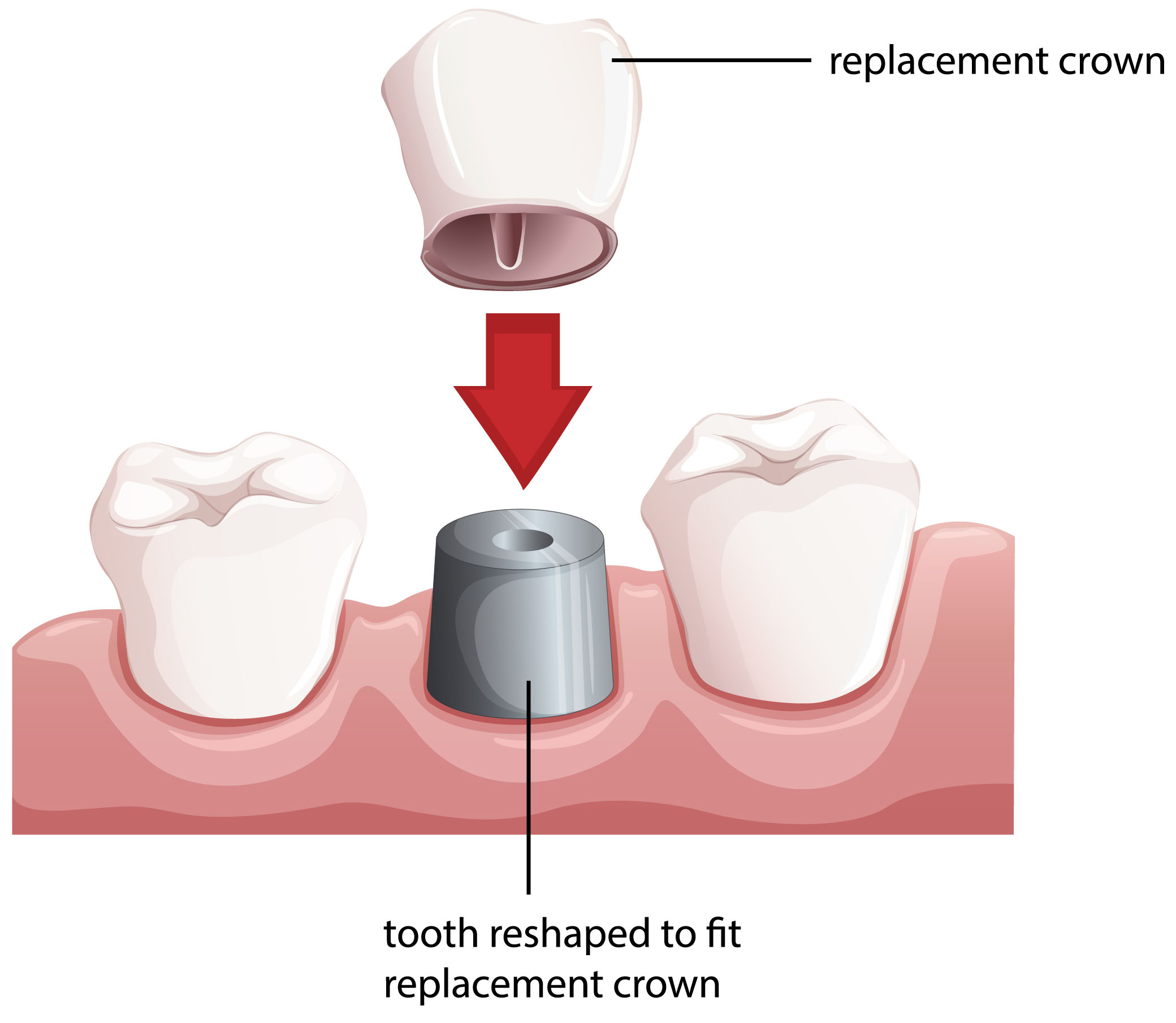 Abbey-Dental-Care-Replacement-Crown-Services.jpg