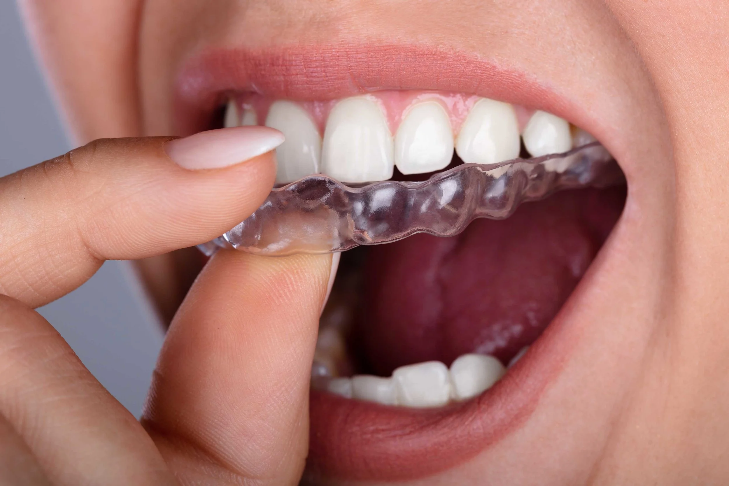 Invisalign-Provider-in-Minster-Thanet-Kent.jpg