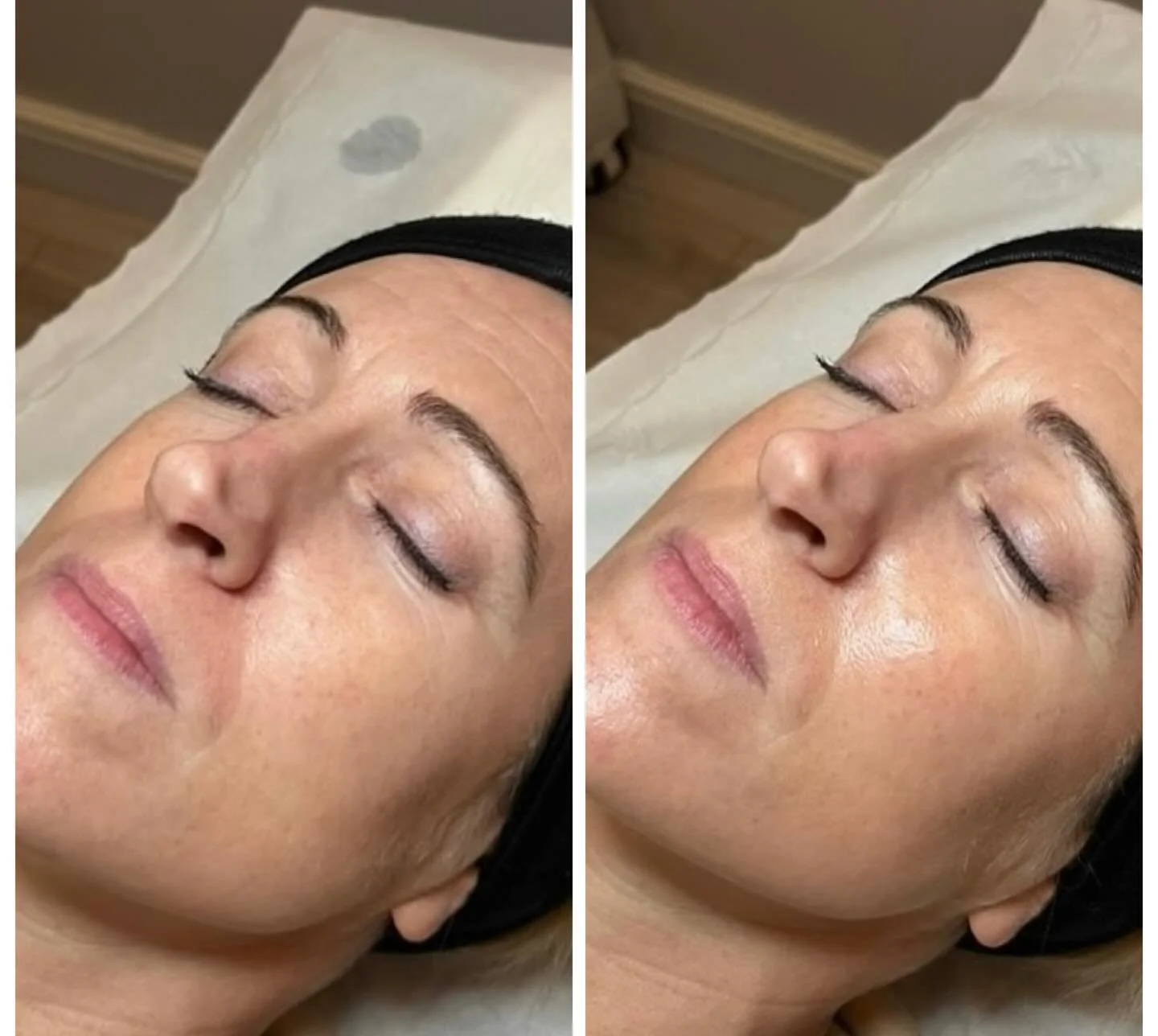 With the return this October of our extremely popular Glow Peel, I am doing a limited time offer to celebrate!!✨
Course of 3 Glow Peels: Was &pound;99
Now: &pound;89
Save &pound;10 if you book your first treatment in OCTOBER🎃👻