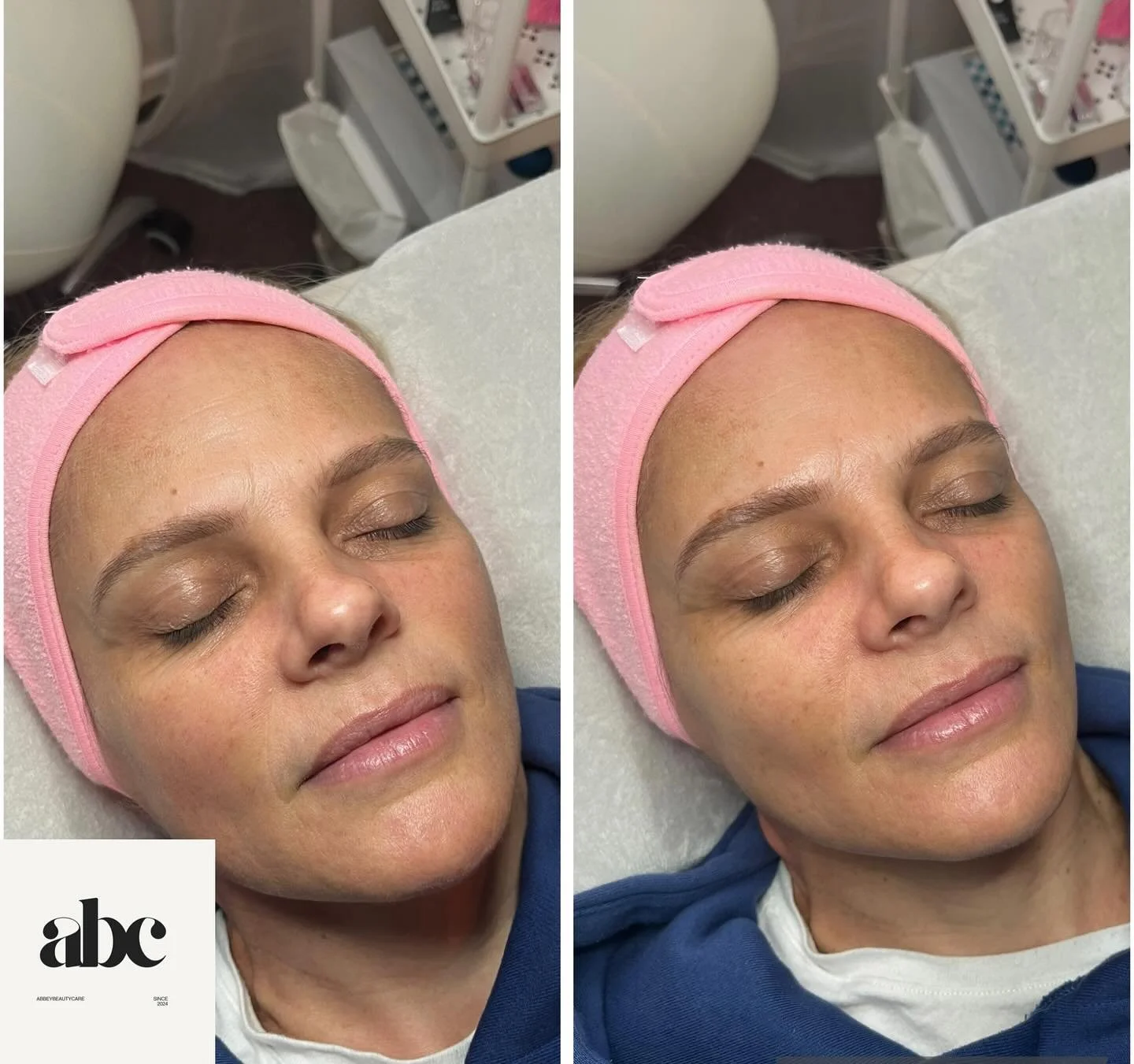 Gorgeous Glow Peel treatment ✨
Amazing results for her 2nd round of this treatment 😍 Keeping skin glowy all year round, this treatment removes the dirty, damaged outer layer of skin to reveal fresh, glowing skin. Not only will this treatment leave y