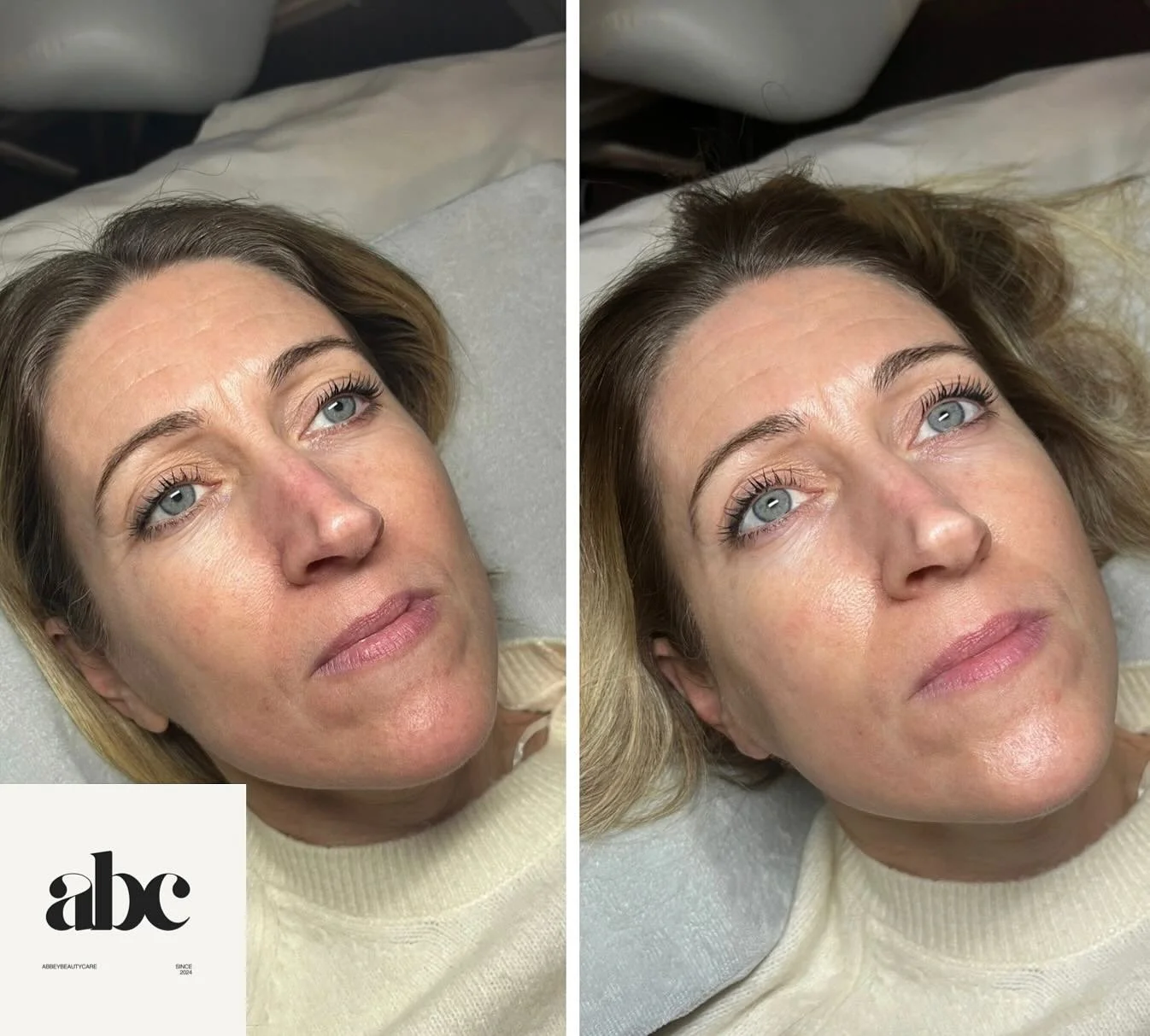 Glowing skin after just one treatment 🤩 Glow peels work to remove dead skin cells and reveal healthier, glowier skin after just one session. This treatment is currently on offer until tomorrow!!! Get booked in now before it&rsquo;s too late 🎃

Gorg