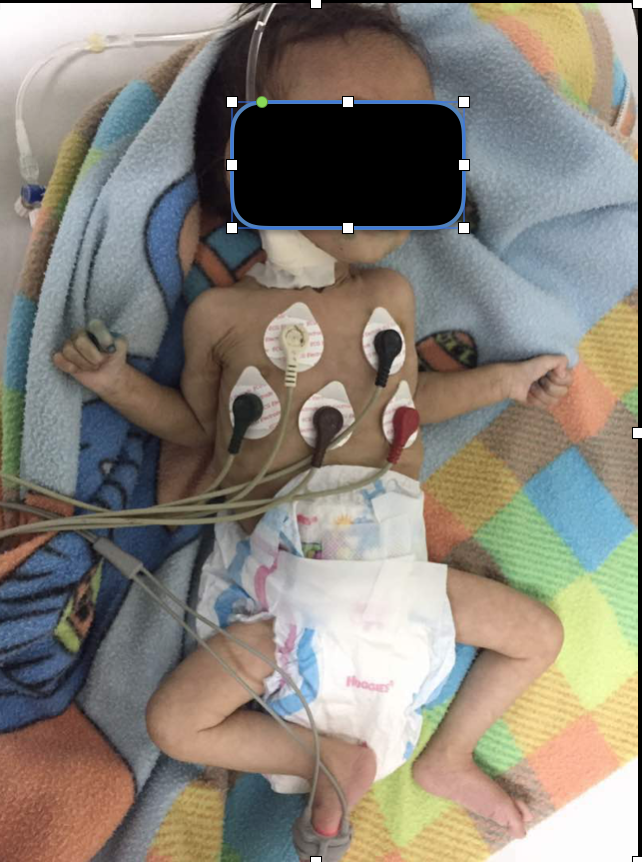 Niño de 11 meses fallecido por desnutrición