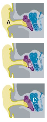 hearing_loss_condtions.png