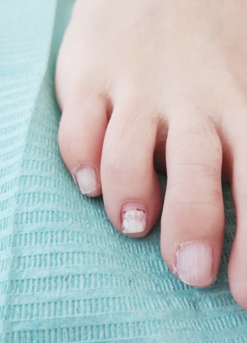 Manchas blancas en las uñas de los pies