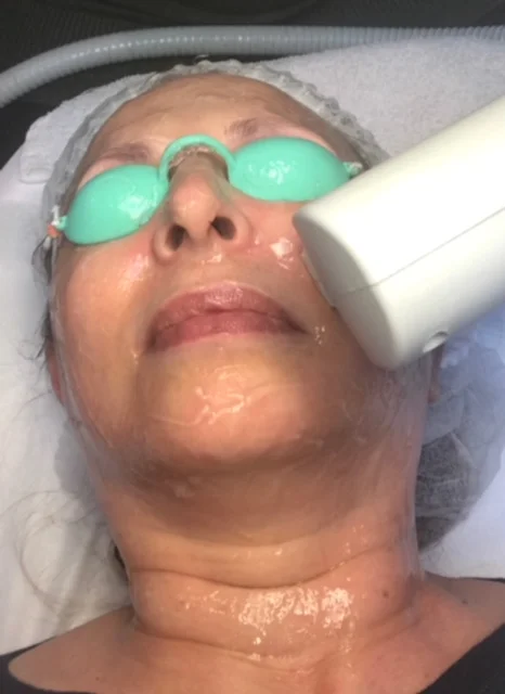 Are Lasers the Answer to Aging Skin?
