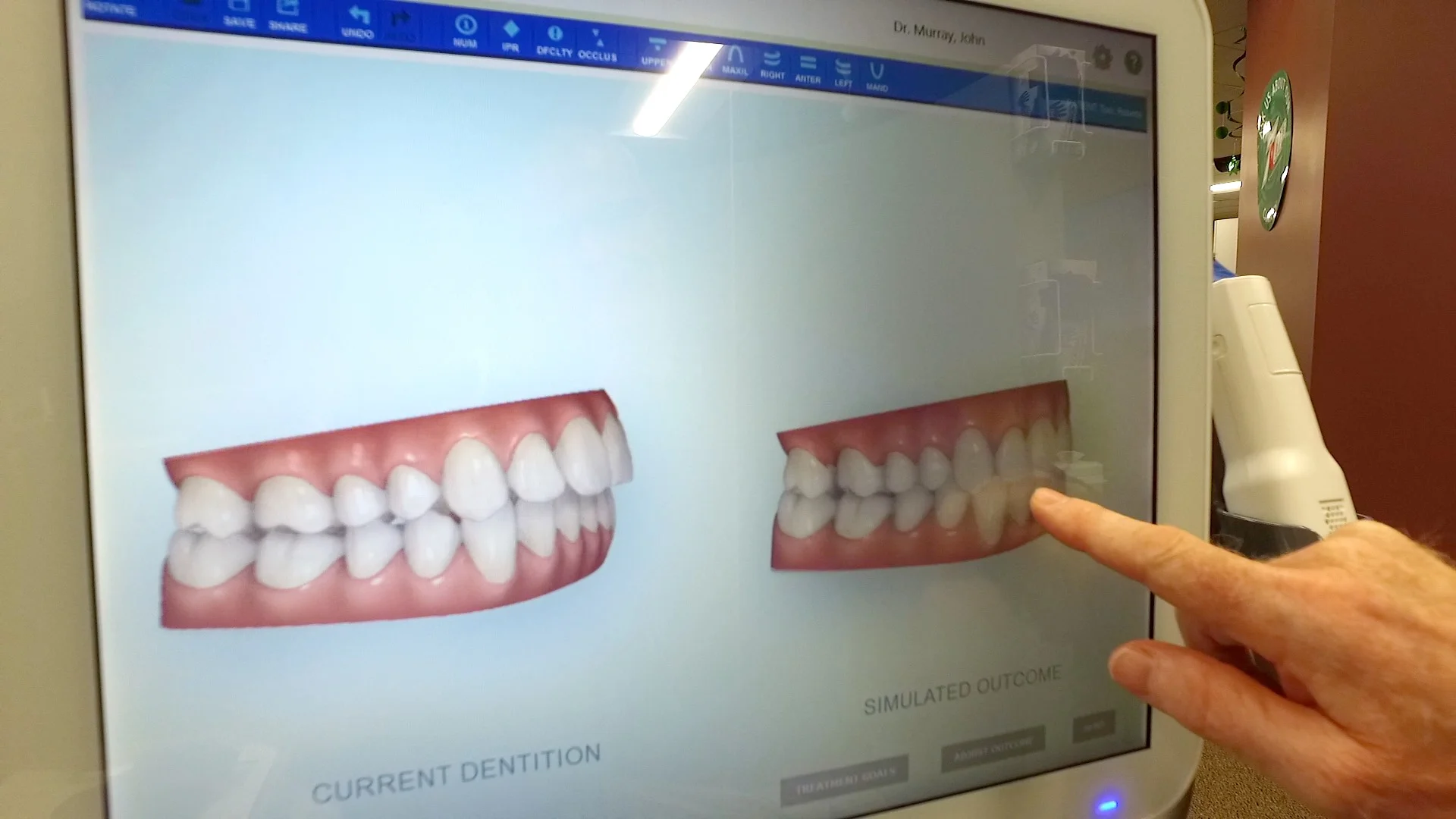 During the initial consultation, Dr. Murray can show patients before and after results from using Invisalign clear aligners.