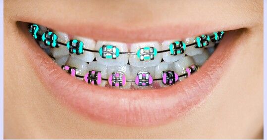 Colored Braces and Bands Murray Orthodontics