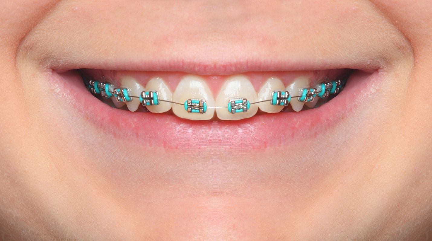 Clear Braces With Purple Bands 