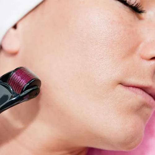 Microneedling