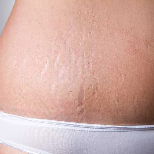 Stretch Marks