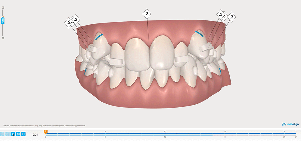 Invisalign ClinCheck bildteknik