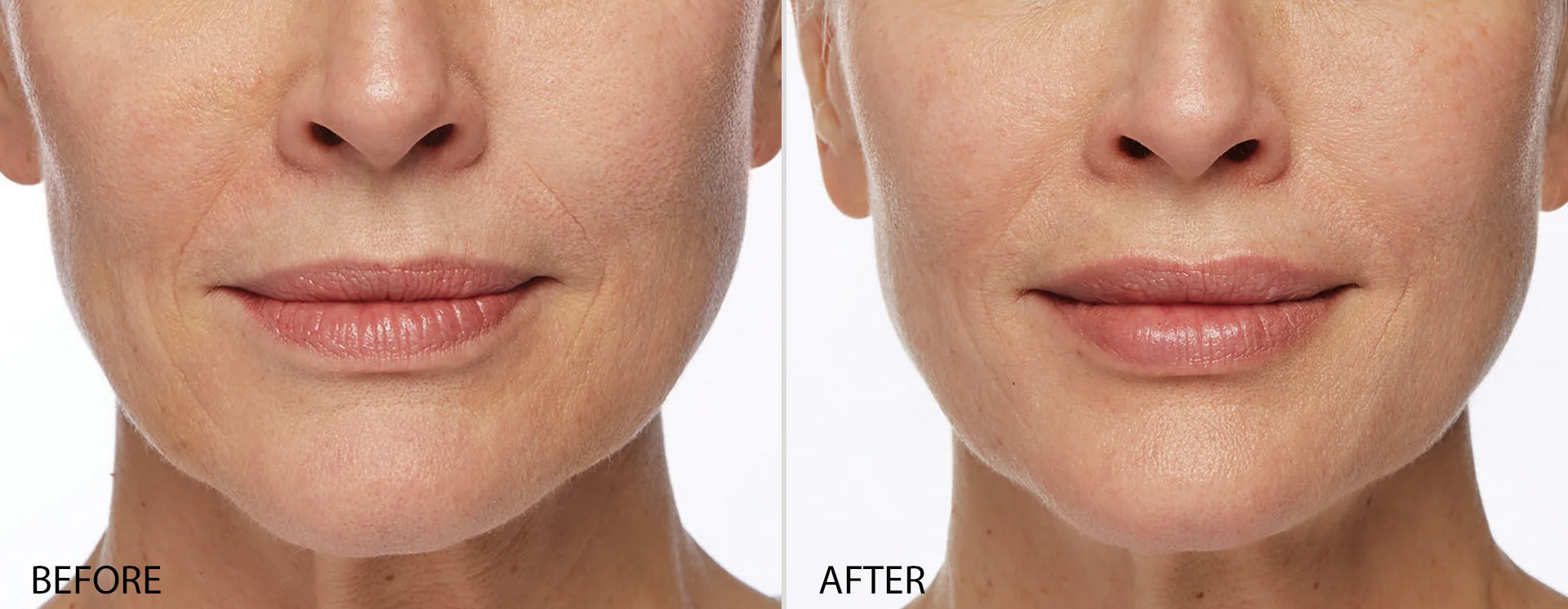 Before Restylane Dermal Filler, Naples FL After Restylane Dermal Filler ( Lips only) Naples, FL