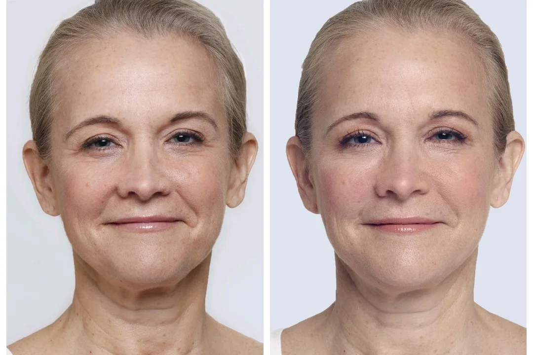 Before Restylane Lyft Naples, Fl After Restylane Naples, FL (Similar results with Juvederm Fillers)