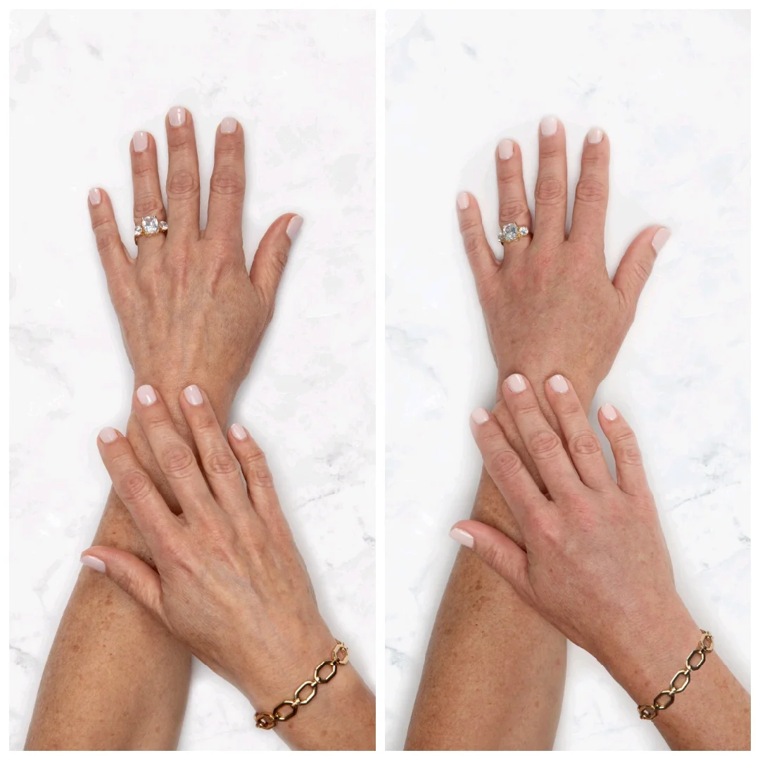 Before Hand Rejuvenation Naples, FL After Hand Rejuvenation Naples, FL