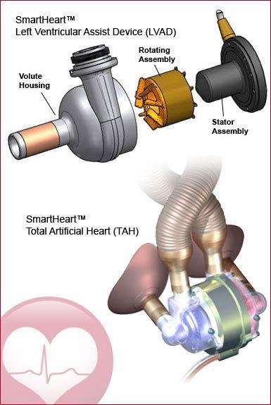 SmartHeart LVAD