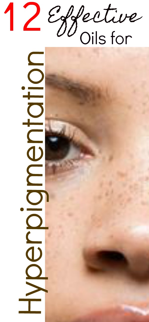 hyperpigmentation.jpg
