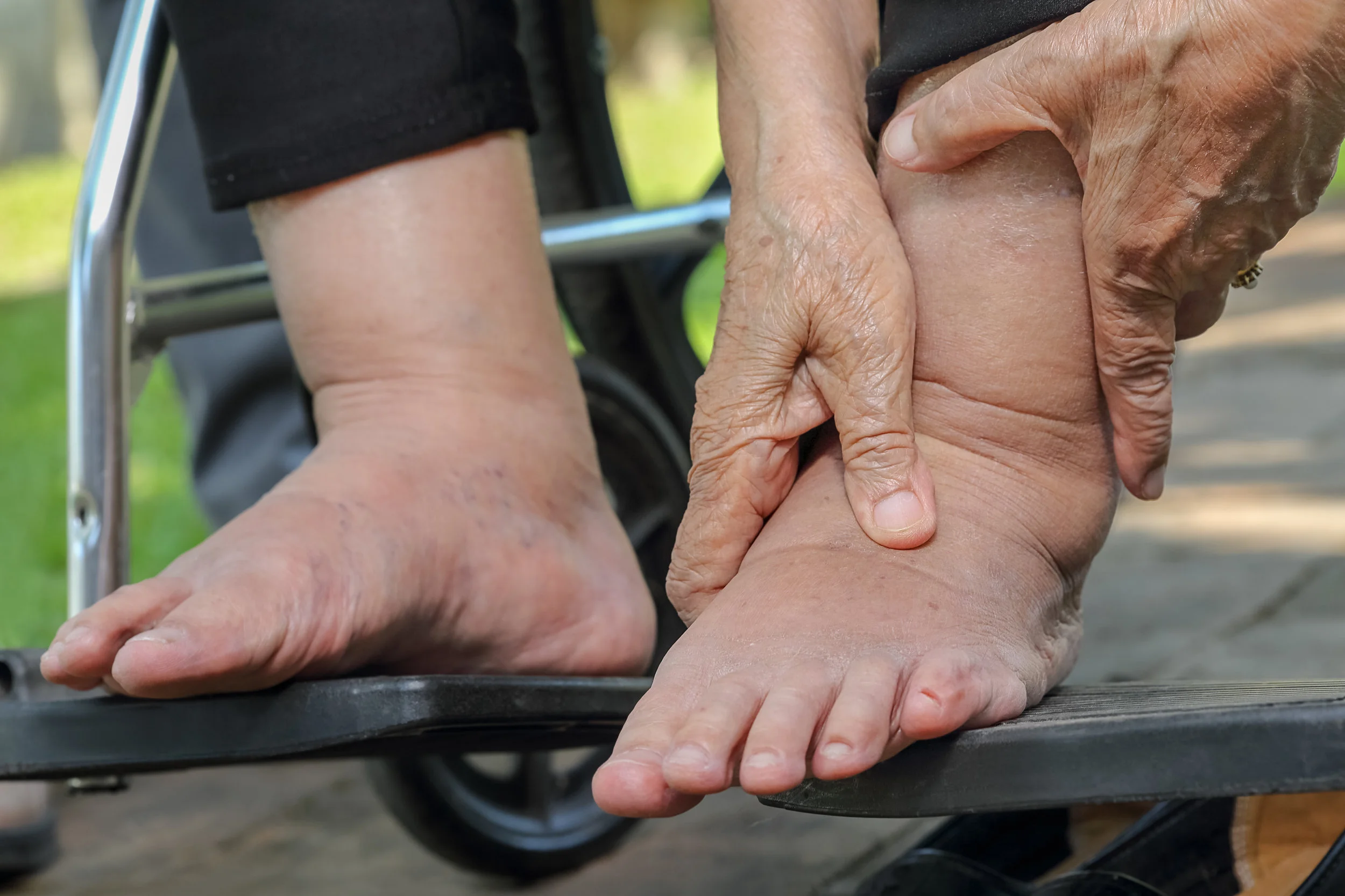 Lipoedema & Lymphoedema: Two different conditions 