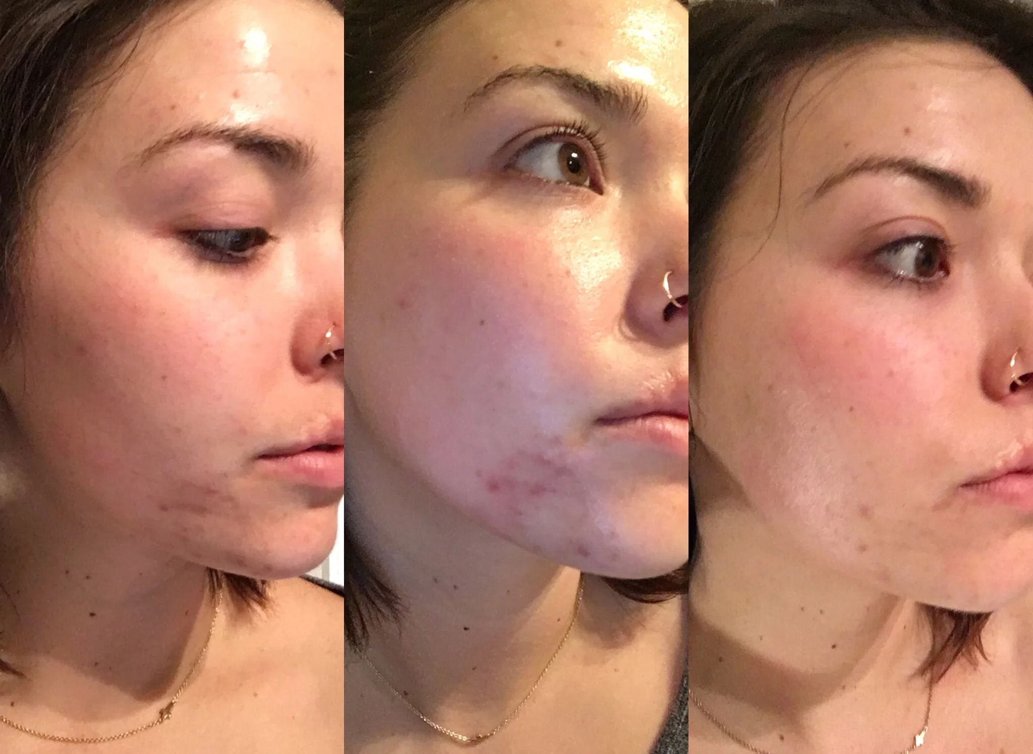 This is the change in my skin after the first month of using Cocokind