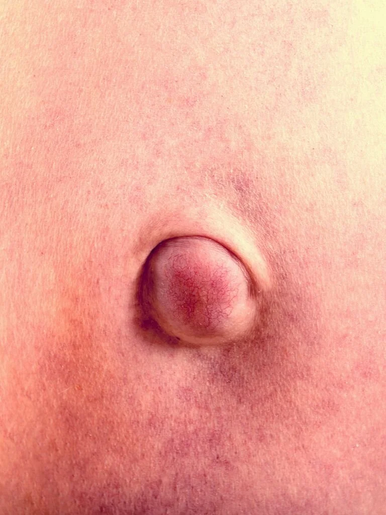 What is an Umbilical Hernia?