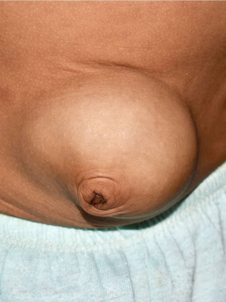 How Serious is a Hernia?