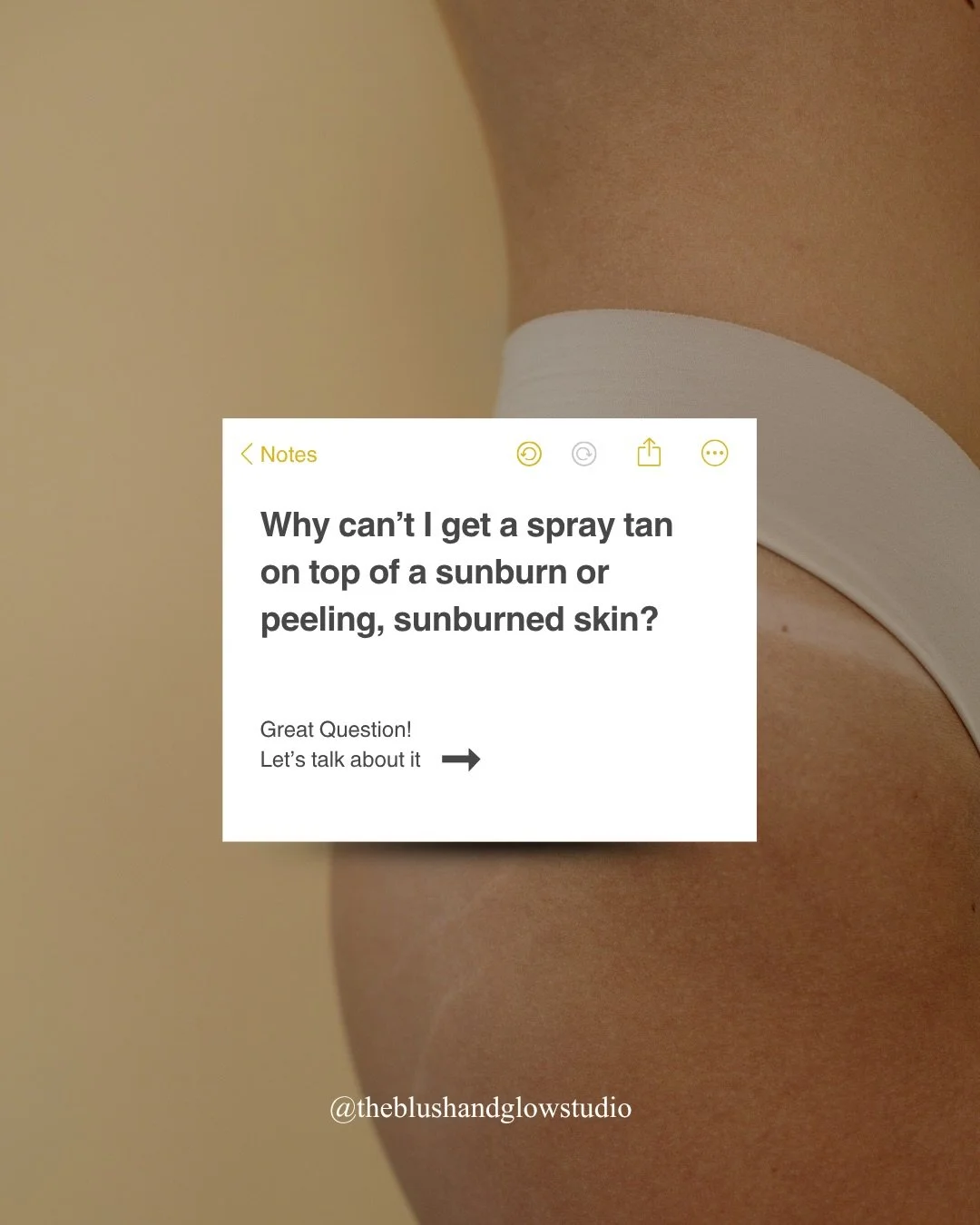 It&rsquo;s sunburn season&hellip; That means it&rsquo;s time to talk about it!

To all of the clients that we have had to turn away because of their sunburned skin &ndash; it&rsquo;s nothing personal, we actually care about you more than you think. W