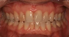 before_teeth.jpg
